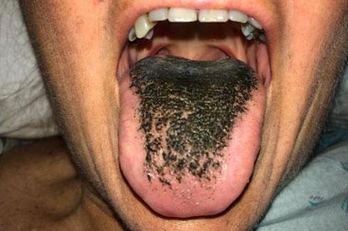 Lý giải hiện tượng lưỡi 'mọc lông đen'