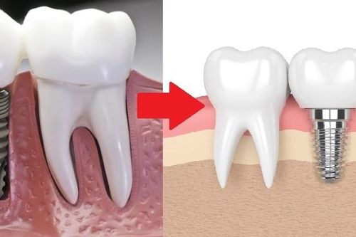 Trồng răng Implant 'Phục hồi toàn diện - Hoàn thiện nụ cười'
