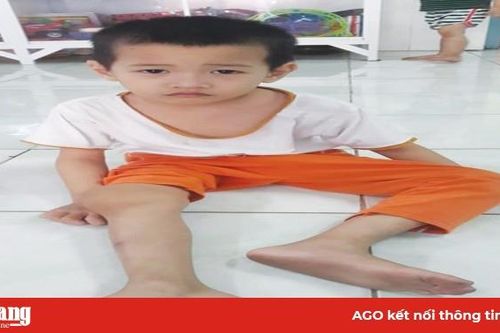Bé trai nghèo bị bệnh máu khó đông cần được giúp đỡ