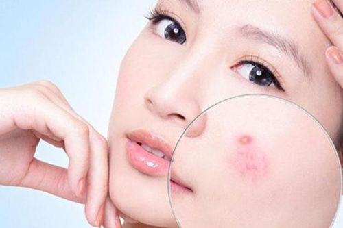 Mụn trứng cá?