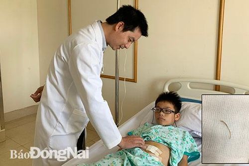 Mổ ruột thừa vì xương cá đâm thủng