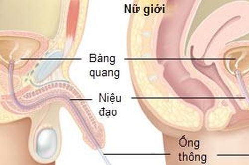 Ðiều cần lưu ý cho người đặt ống thông bàng quang