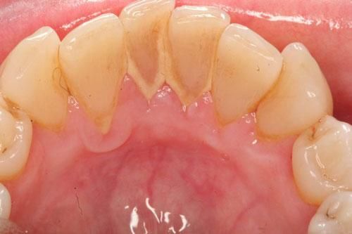 Không cần đi nha sỹ lấy cao răng tốn kém, chỉ cần bạn biết sử dụng những nguyên liệu có sẵn trong bếp này