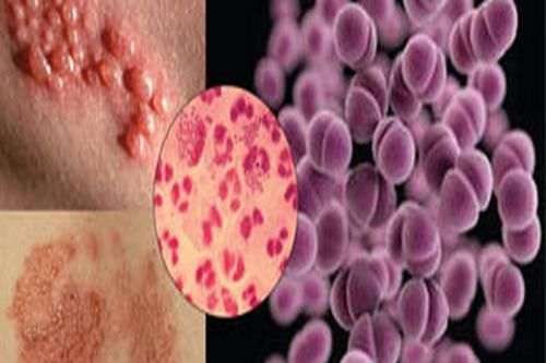 Biến chứng đáng ngại của bệnh lậu