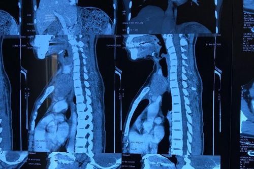 Cô gái trẻ có khối u tuyến ức lạc chỗ cực kỳ hiếm gặp, thế giới chỉ có vài ca