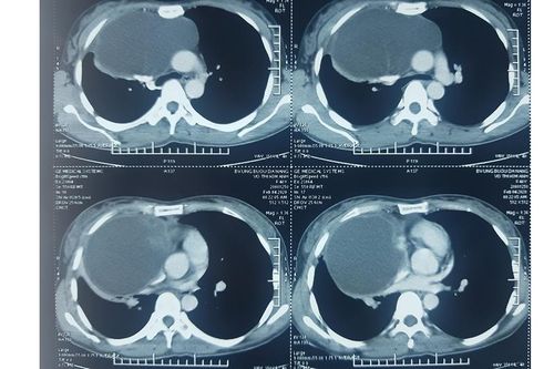 Phẫu thuật thành công khối u trung thất lớn chèn ép tim phổi