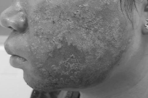 Da mặt nhiễm trùng, mưng mủ sau lăn kim tại spa
