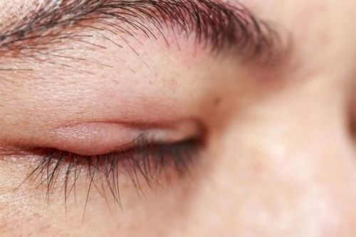 Vì sao bị viêm bờ mi?