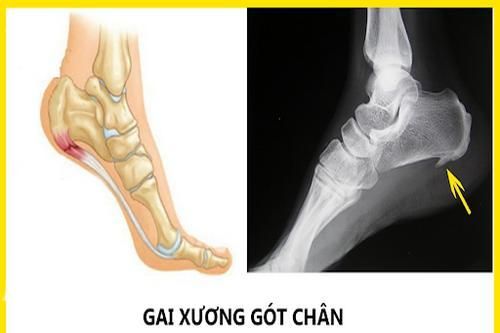 Thường xuyên đau gót chân, bệnh gì?