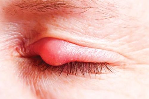 Mụt lẹo và bài thuốc Nam trị bệnh