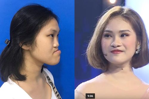 9X Phú Thọ 'như được hồi sinh' sau 3 ca đại phẫu gương mặt