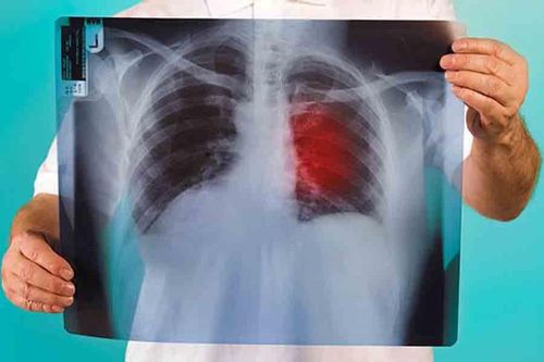 Phương pháp đột phá đưa phổi ra khỏi cơ thể để 'làm sạch' ung thư