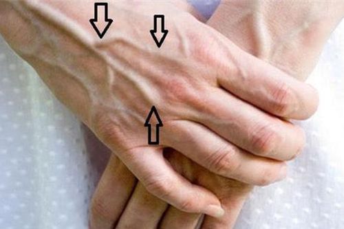 Dấu hiệu trên bàn tay cảnh báo gan đang nhiễm độc, 'nhàu nát' từng ngày, nguy hại nhất là số 1