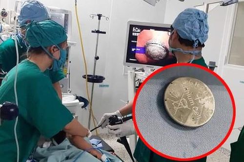 Bé gái 16 tháng tuổi suýt bị loét dạ dày khi nuốt phải viên pin trong đồ chơi