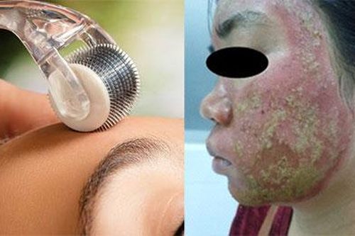 Tai biến do làm đẹp bằng phương pháp lăn kim