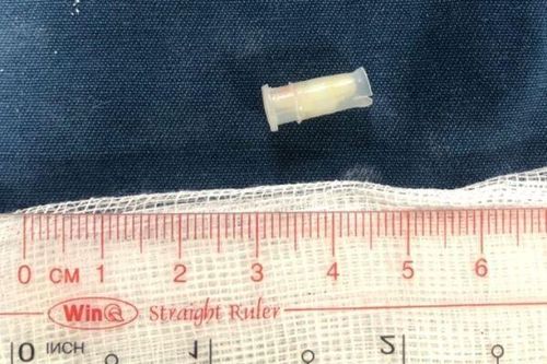 Bị sặc trong lúc chơi, cháu bé 3 tuổi nguy kịch vì nuốt chiếc còi nhựa vào phế quản