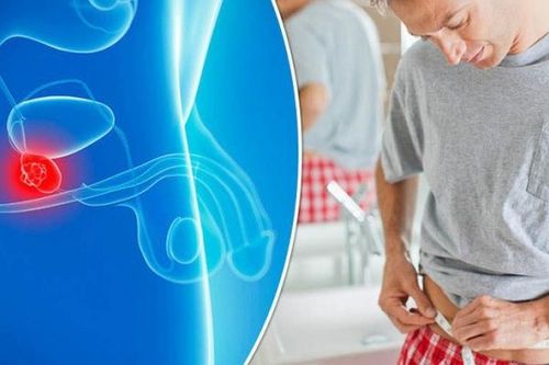 Làm gì để phát hiện ung thư tuyến tiền liệt sớm?