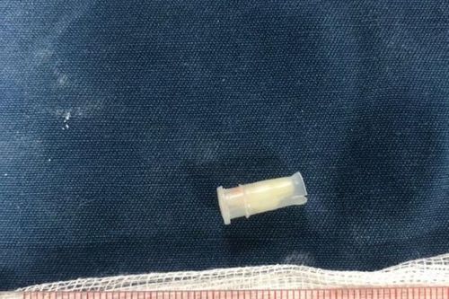 Bệnh nhi 3 tuổi tím tái cơ thể vì hóc dị vật chiếc còi trong phế quản