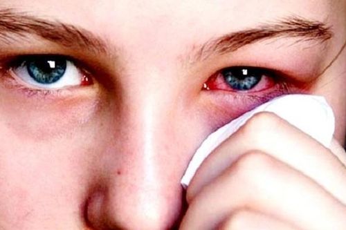 Ảnh hưởng của bệnh viêm kết mạc mùa xuân