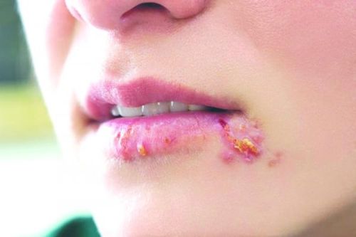 Bệnh mụn rộp có lây lan?