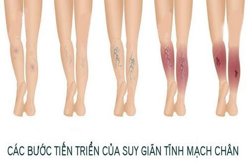 Suy giãn tĩnh mạch chân - âm thầm nhưng đau đớn