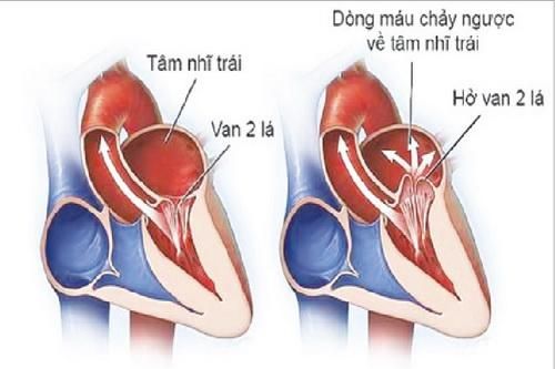 Bài thuốc phòng trị thấp tim