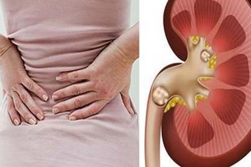 Chuyên gia chỉ rõ 6 thói quen xấu gây sỏi thận người Việt hay mắc phải