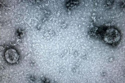 Lần đầu tiên phát hiện virus corona trong dịch não tủy của bệnh nhân