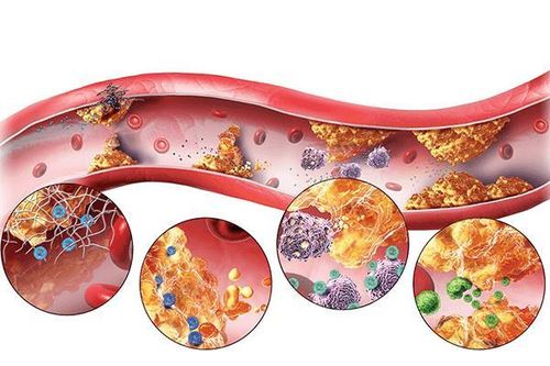 Người thừa cân, béo phì và rối loạn lipid máu trong các doanh nghiệp