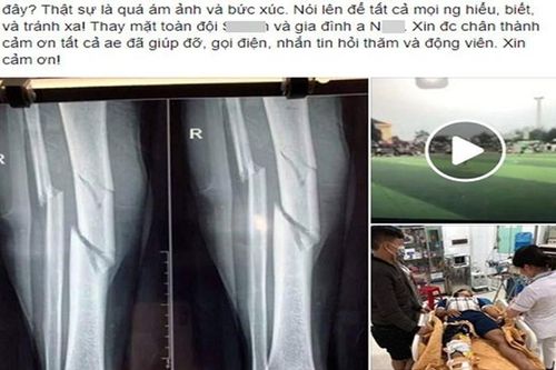 Cầu thủ đốn giò' đối phương khiến xương gãy 3 khúc