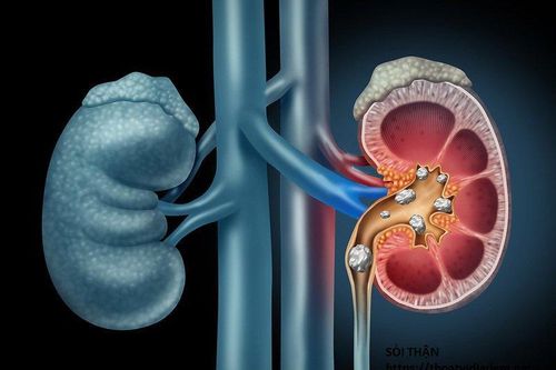 5 dấu hiệu cảnh báo sỏi thận bạn cần chú ý