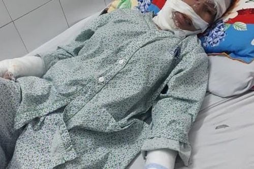 Xót xa mẹ đơn thân nghèo bị bỏng nặng xin về nhà vì không có tiền điều trị
