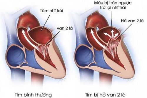 Những điều bạn nên biết về hở van tim 2 lá