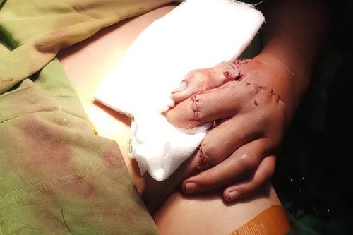 Thiếu niên 15 tuổi bị dập nát bàn tay do chế tạo pháo