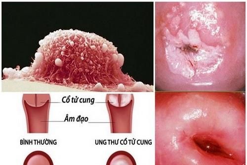 Lây nhiễm HPV và nguy cơ ung thư cổ tử cung