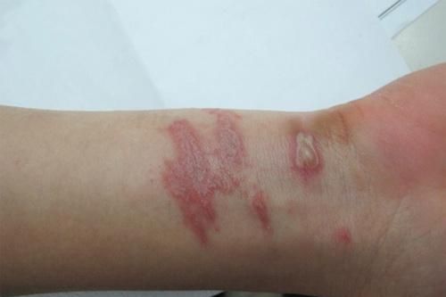 Xử lý nhanh viêm da tiếp xúc do côn trùng
