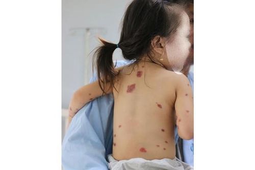 Điều trị thành công bệnh nhi bị hội chứng Steven Jonhson