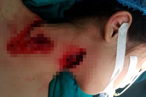 Nhiều trẻ nhập viện do tai nạn sinh hoạt