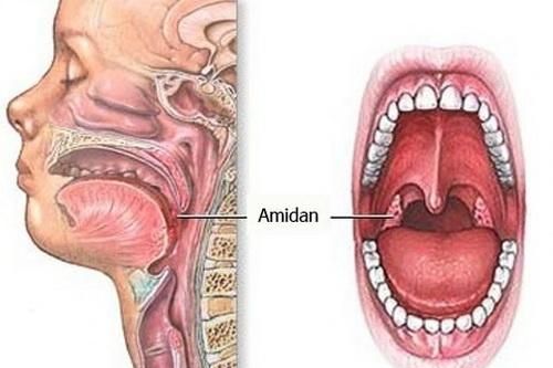 Đừng để viêm amidan trở thành áp-xe