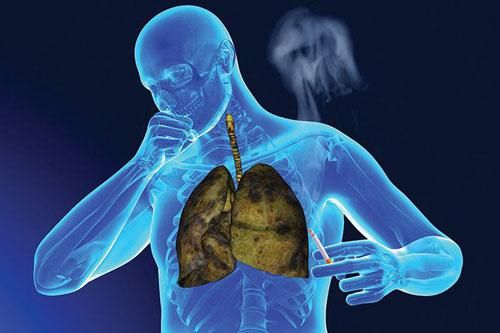 Nếu bàn tay có dấu hiệu này hãy đi khám ngay kẻo ung thư phổi sắp 'ghé thăm' bạn