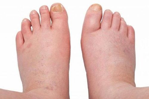 Nguyên nhân dẫn đến bệnh phù