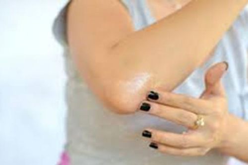 Viêm lồi cầu ngoài xương cánh tay