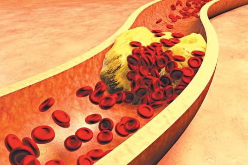Điều trị tăng cholesterol sau 7 năm vẫn nhồi máu cơ tim