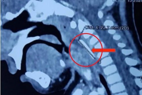 Bé 18 tháng tuổi bị nĩa đâm vào họng khi đang đùa nghịch