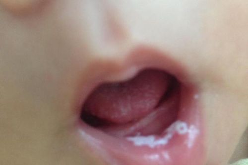 Bệnh vi nấm hạt men ở trẻ em