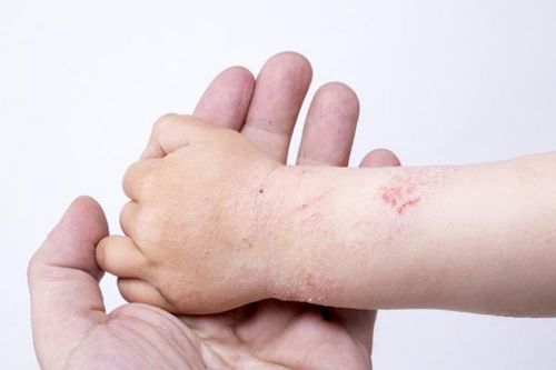 Viêm da cơ địa: Những điều cần biết