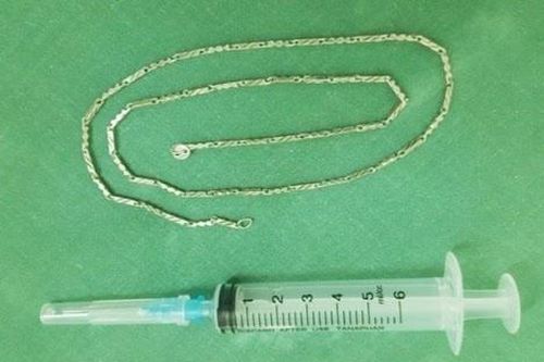 Sợi dây chuyền dài gần 40 cm trong dạ dày bé 2 tuổi