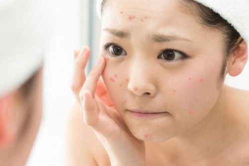 Bài thuốc hay trị mụn trứng cá