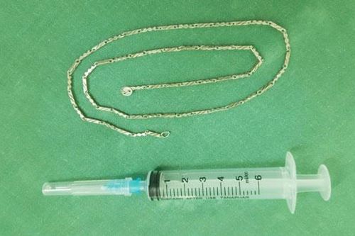 Nội soi dạ dày dây chuyền bạc dài gần 40 cm ở trẻ hơn 2 tuổi