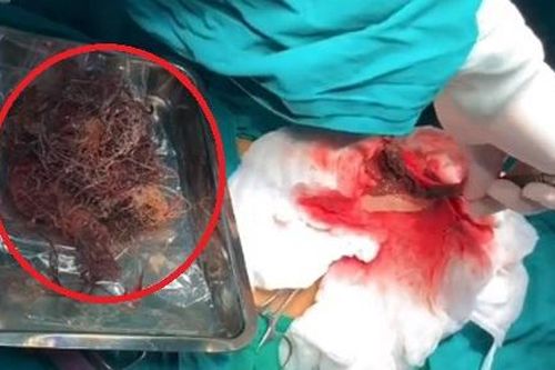 Dạ dày bé gái 7 tuổi chứa toàn tóc, sợi nilon, dây thun cột tóc